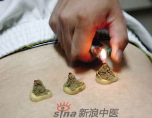 灸法的種類  你知道多少？